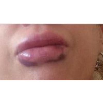 Víctima de la clínica estética de Pamplona que actuaba sin titulación médica: “Fue horrible, me destrozaron los labios”
