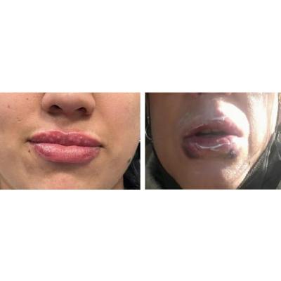 Una de las investigadas en Pamplona por intervenciones estéticas en labios defiende su formación