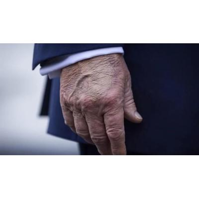 ‘Síndrome del apretón de manos’, la dolencia que esconde un gesto tan común