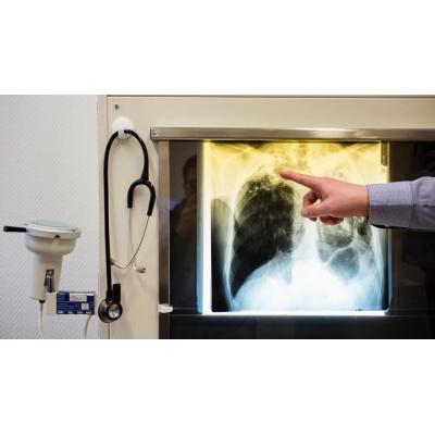 Detectan un brote de tuberculosis entre el personal del Instituto de Medicina Legal de Toledo