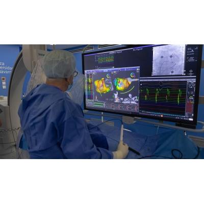 Primer paso en España: cardiólogos de Navarra investigan un método más eficaz y personalizado para tratar arritmias