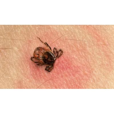 Picaduras de garrapata: cómo prevenirlas y cuándo preocuparse