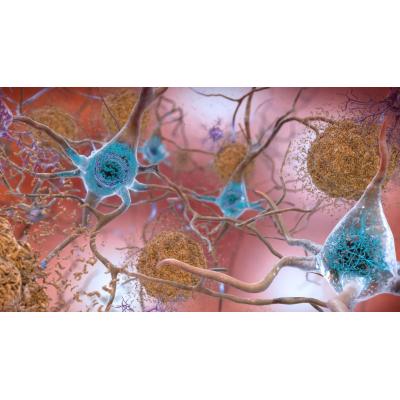 Un fragmento de anticuerpo previene las hemorragias de los nuevos tratamientos del Alzheimer