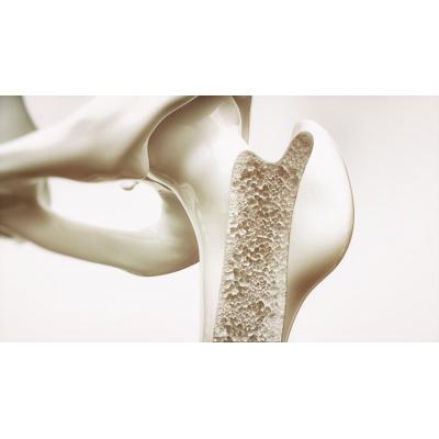 El TAC lumbar podría adelantar la detección de osteoporosis y anticipar nuevas fracturas, según un estudio